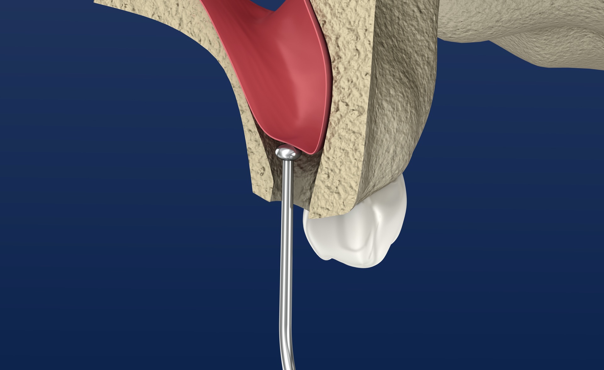 Zirconia Implants in Sinus Augmentation Procedures