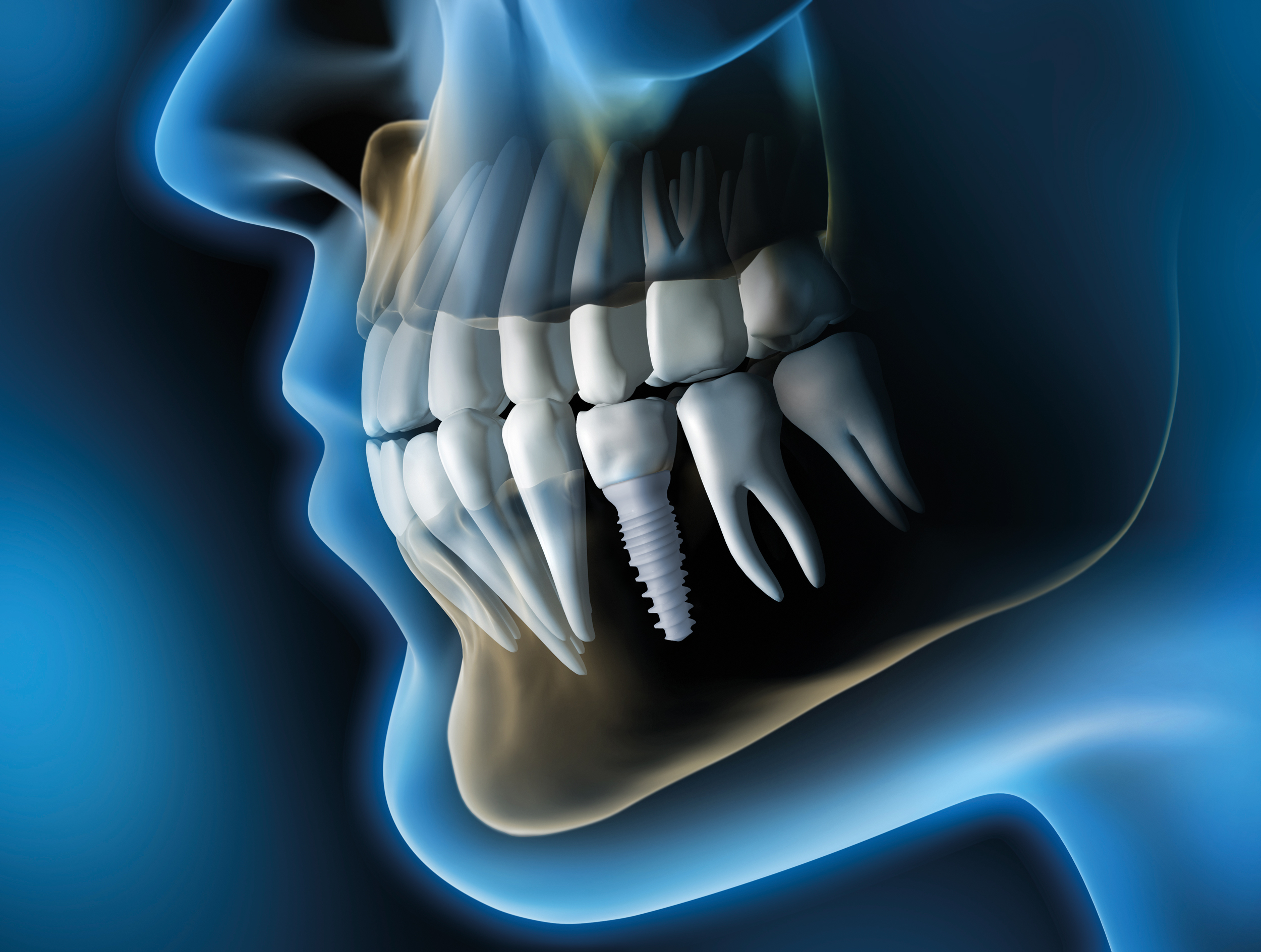 The Science and Long-Term History of Zirconia Implants